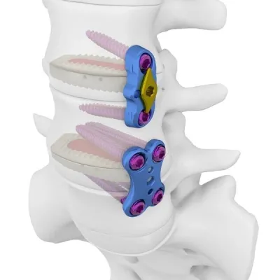 Minimally invasive surgery