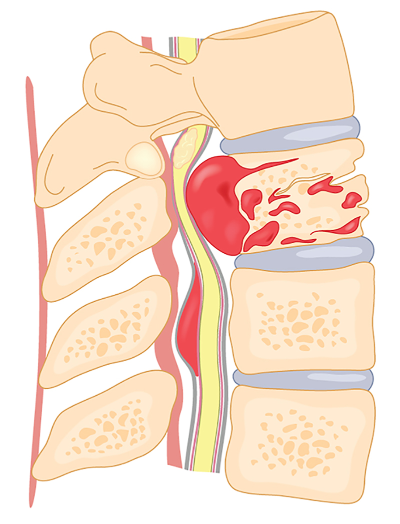 Spinal tumours and infections